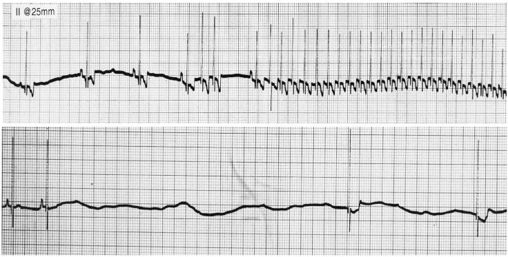 indian school girl kissing and getting fucked ekg strip of sick sinus syndrome